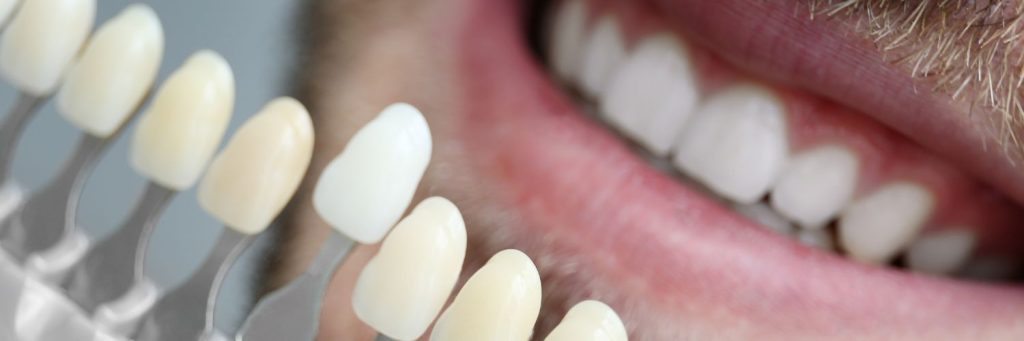 Are Veneers Reversible?