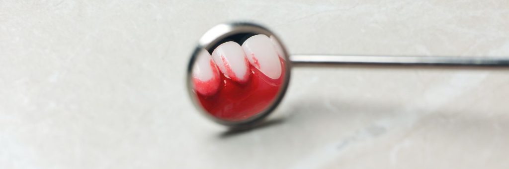 Can I have a dental bridge if I have gum disease