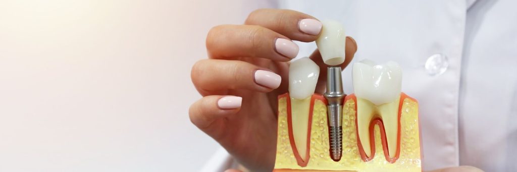 The Importance of Bone Density for Dental Implants